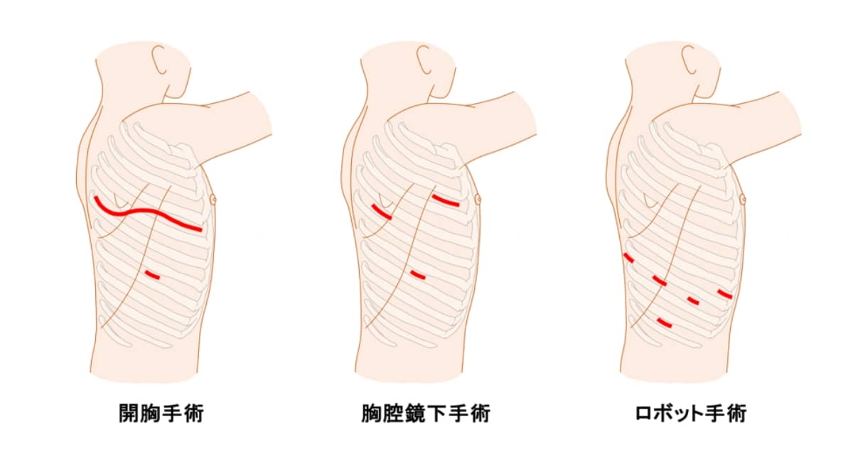 肺がんに対する手術の主なアプローチ方法 イメージ図