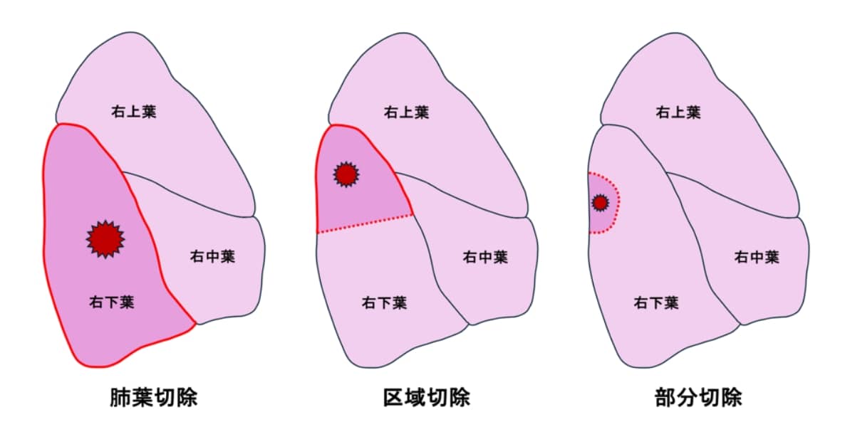 肺切除量を縮小する縮小手術 イメージ図